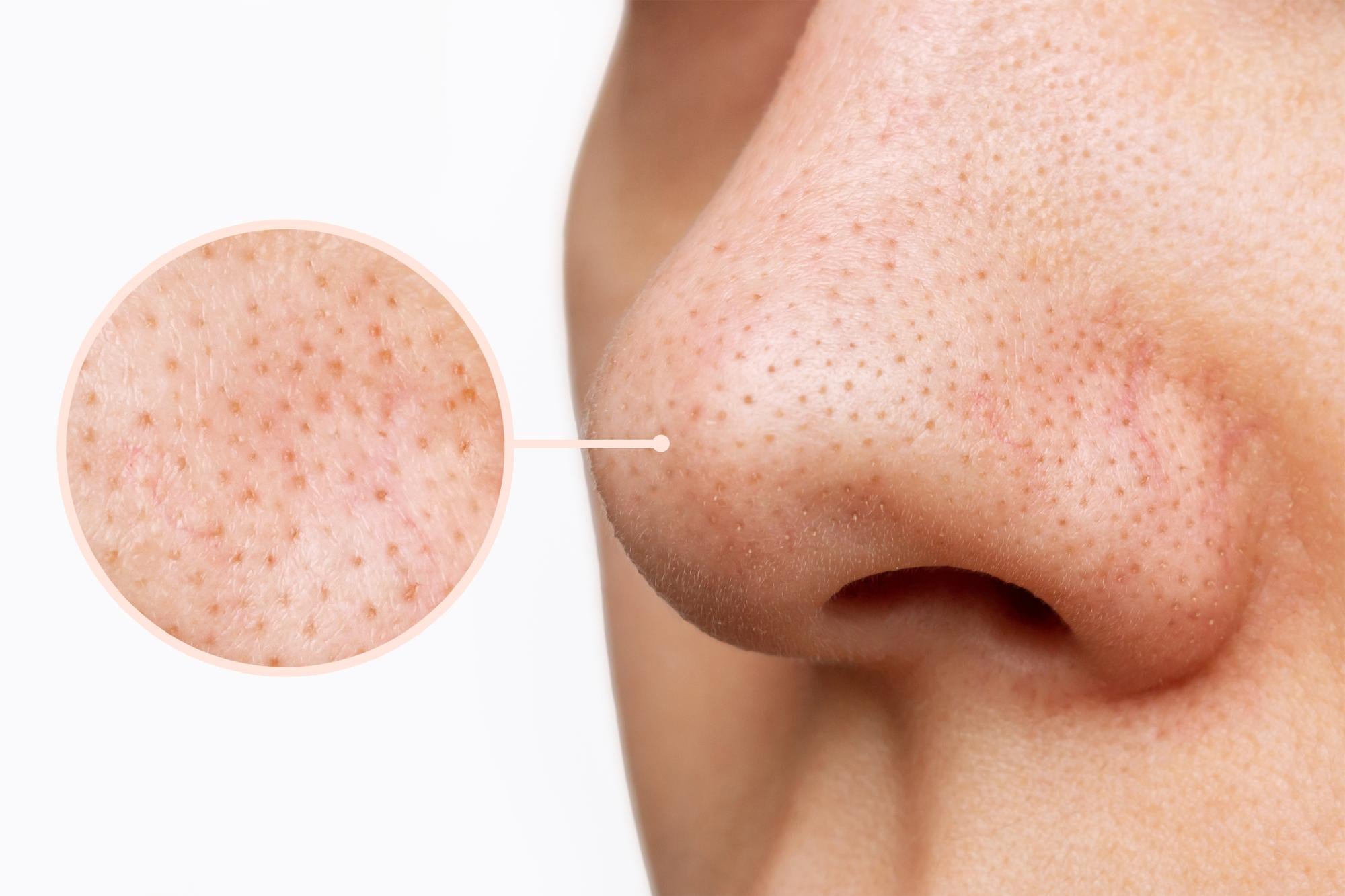 How to Shrink Large Pores Naturally with Ayurvedic Herbs?