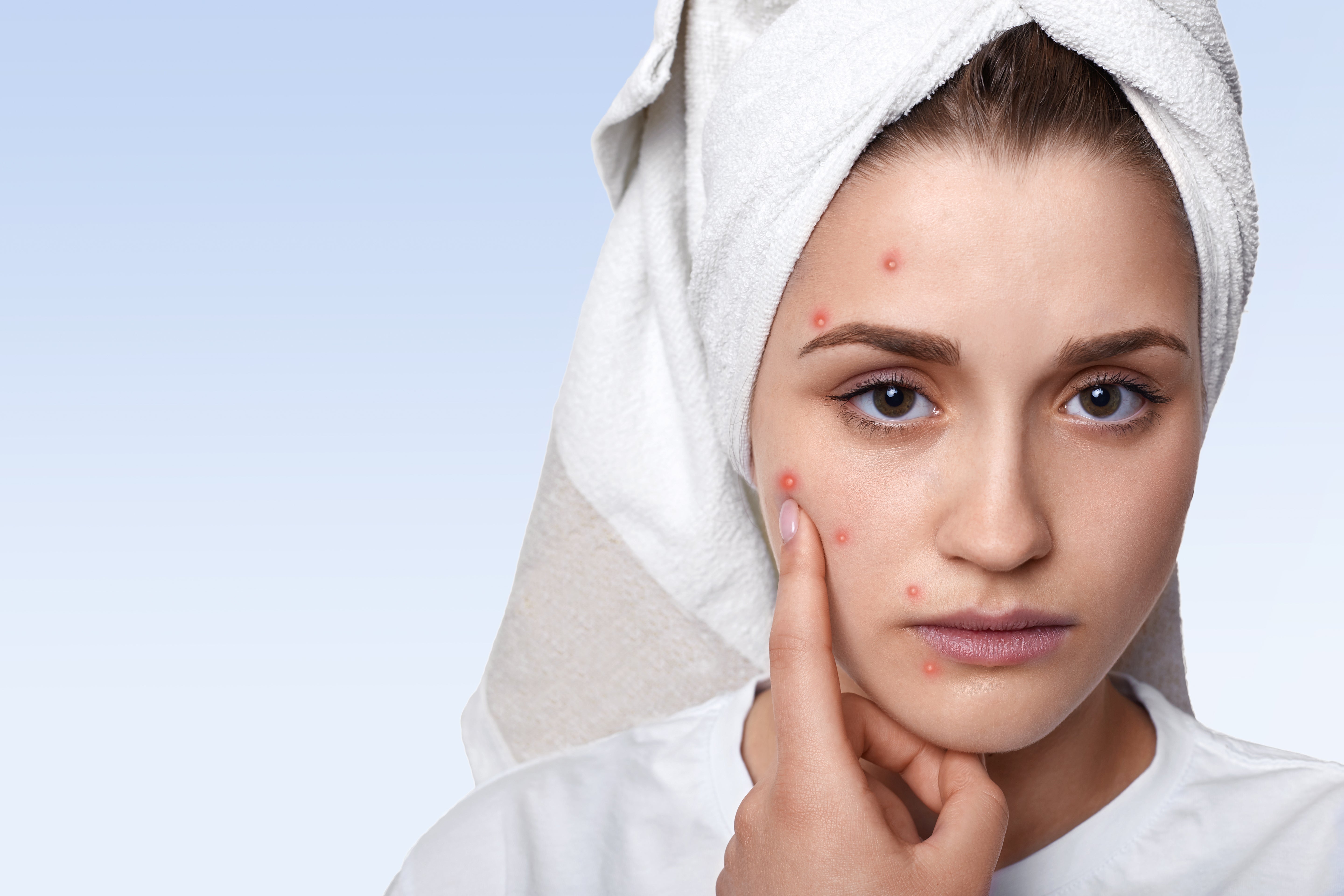 How to Get Rid of Pimples Naturally with Ayurveda: A Complete Guide