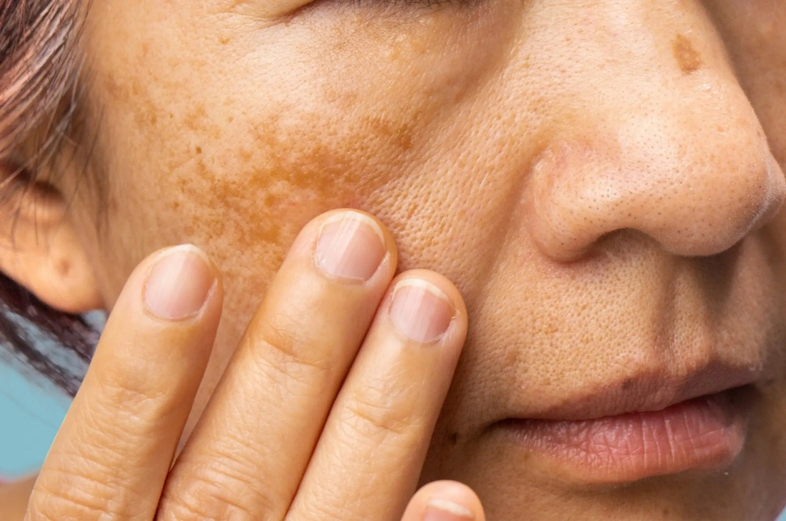 Ancient Ayurvedic remedies for Melasma and Skin Discoloration